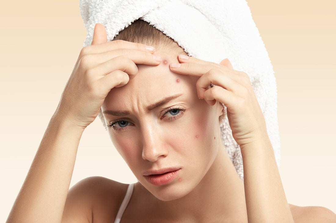7 Bizarre Acne Facts You Need To Know | Kiss Selfcare