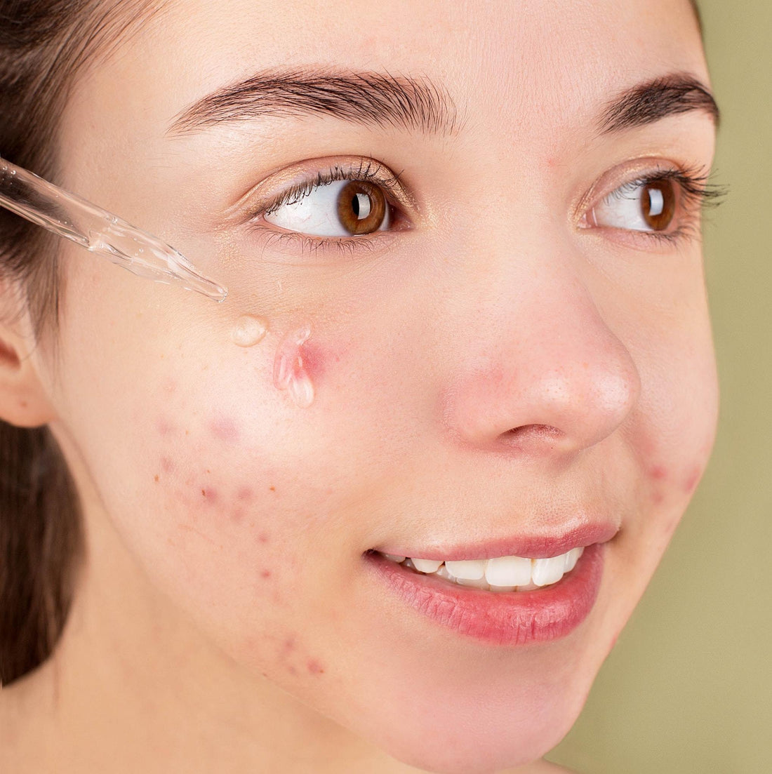 Acne Scars: Can They Be Removed? | Kiss Selfcare